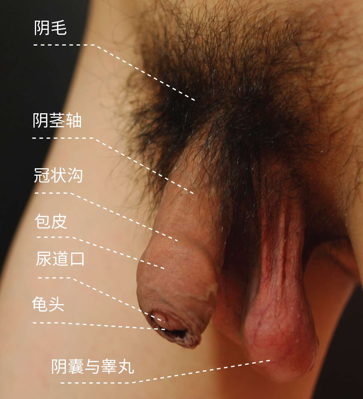 圖 9， 亞洲男性外生殖器（疲軟狀態，包皮覆蓋）