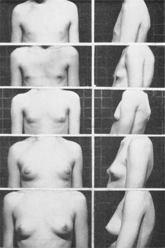 圖5，乳房發育的五個階段，如上文描述。