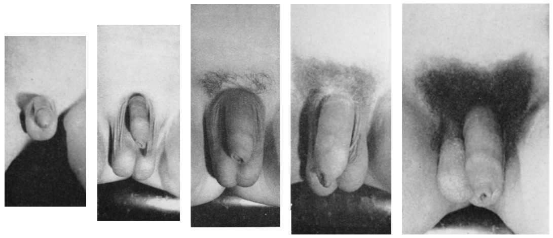 圖6，男性外陰發育的五個階段，如上文描述。