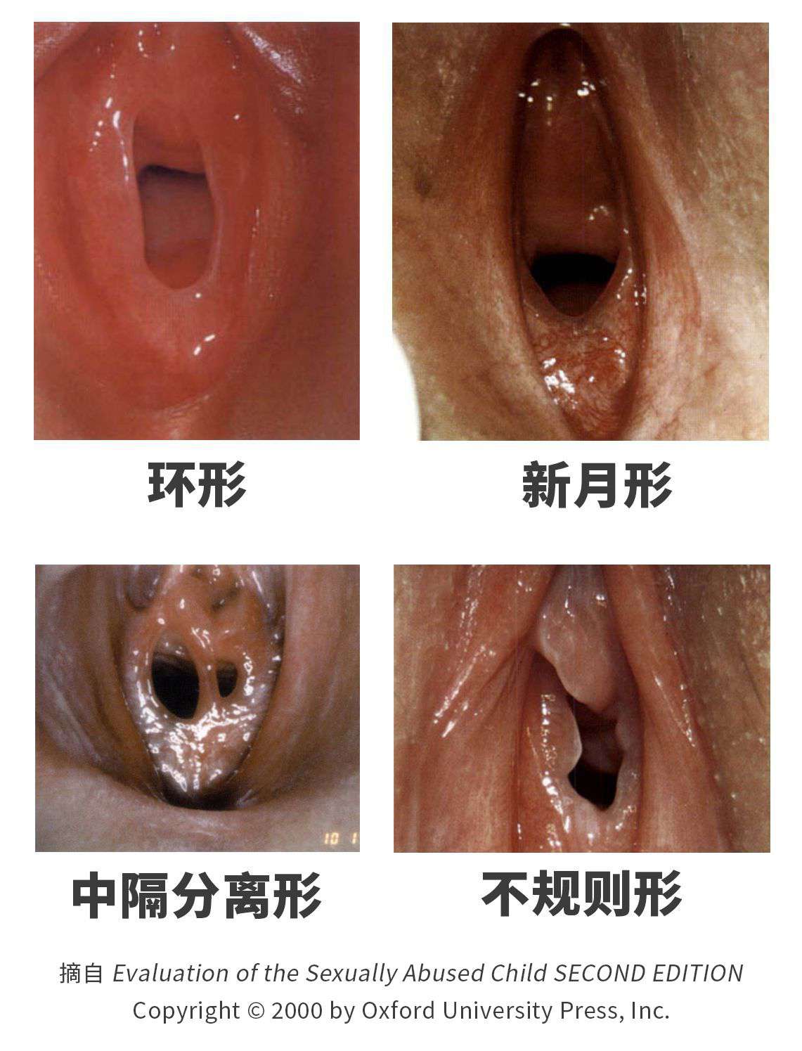 圖 6，處女膜的其中四種形態